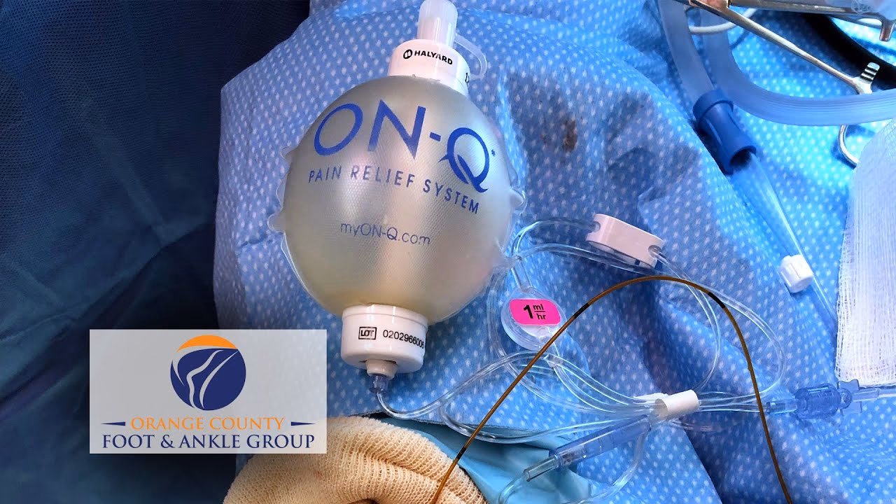 What are the side effects of on-Q pain pump?