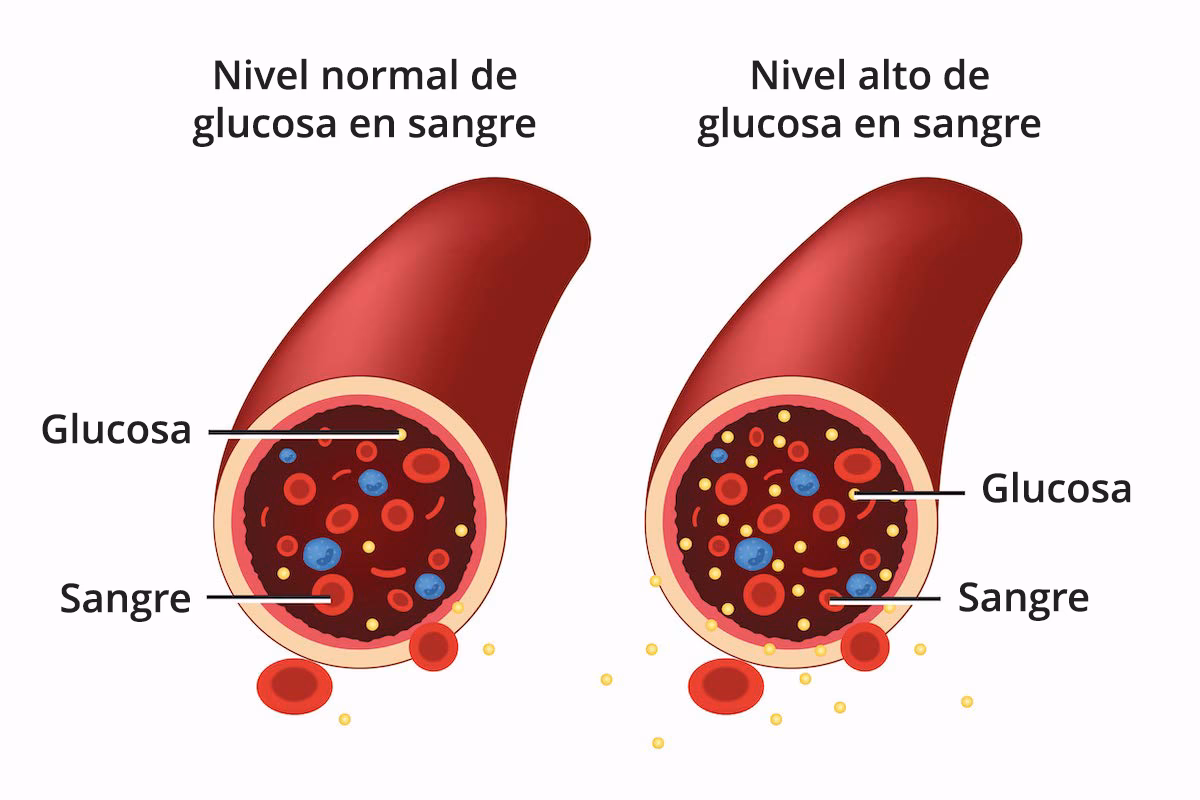 ¿Cuáles son los tipos de diabetes?