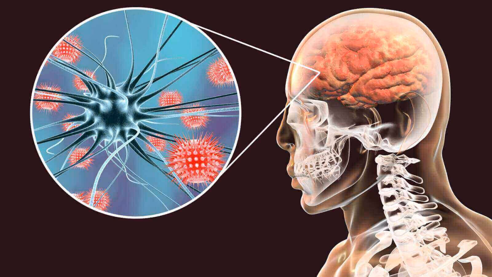 ¿Cuáles son los síntomas de la meningitis bacteriana?