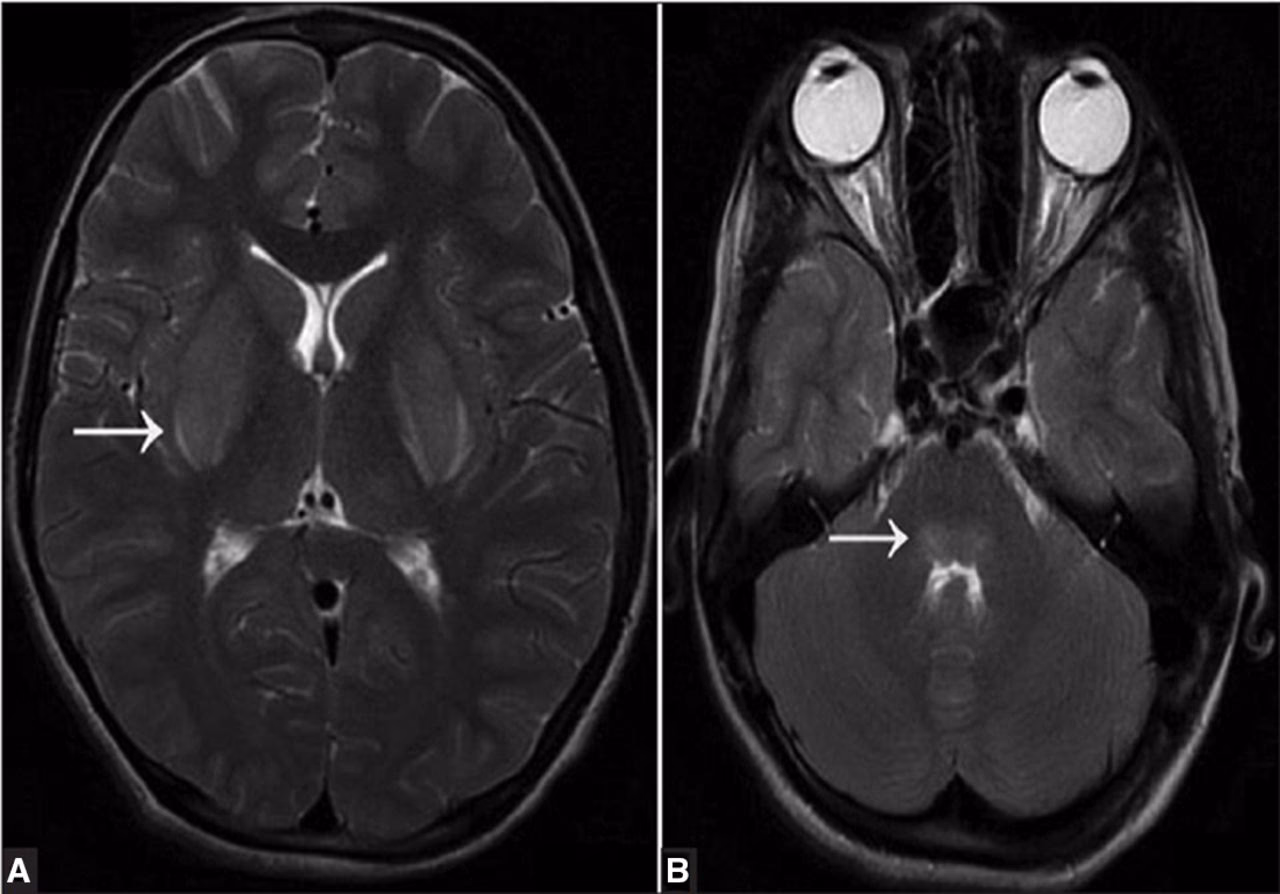 Can brain tissue be used to diagnose rabies in animals?