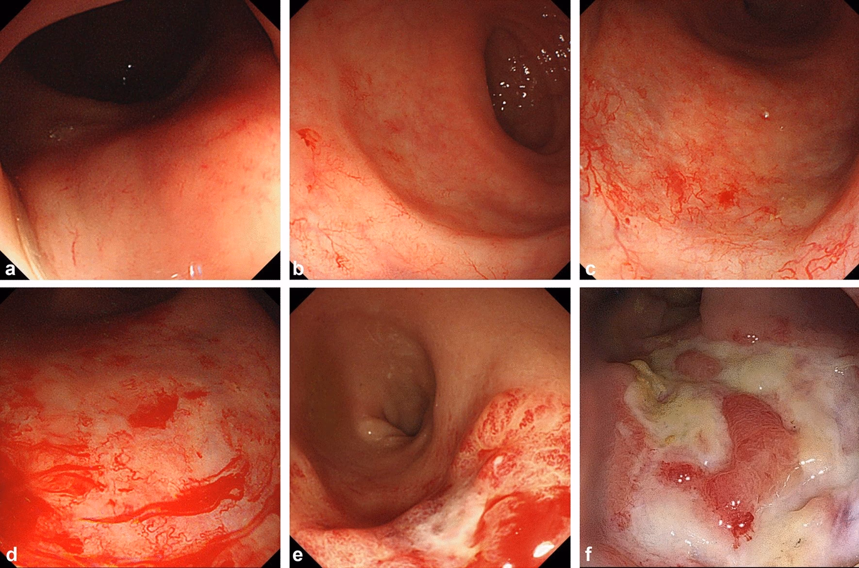 When should I call a doctor if I have rectal bleeding?