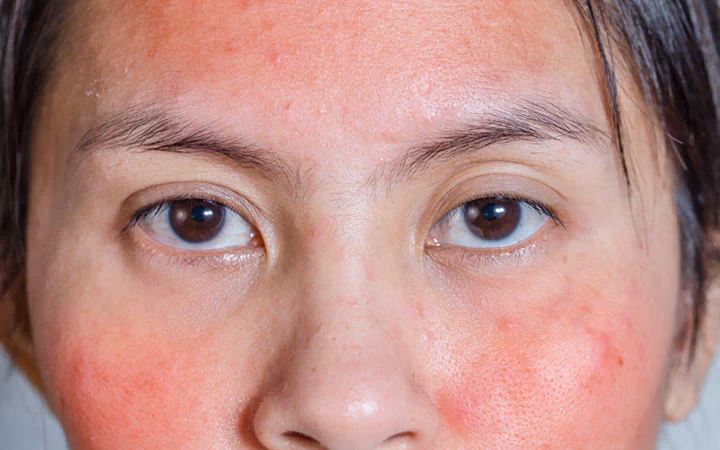 What causes a red rash on the face?