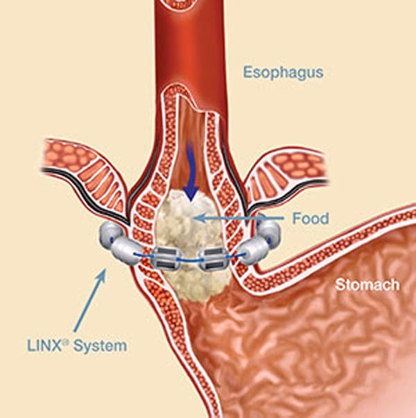 When was the first Linx reflux management system procedure performed?