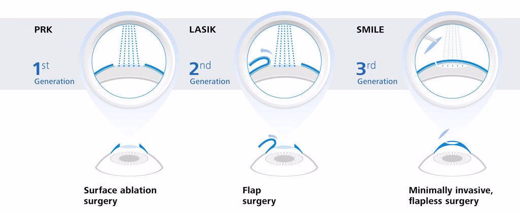 Are refractive procedures safe?