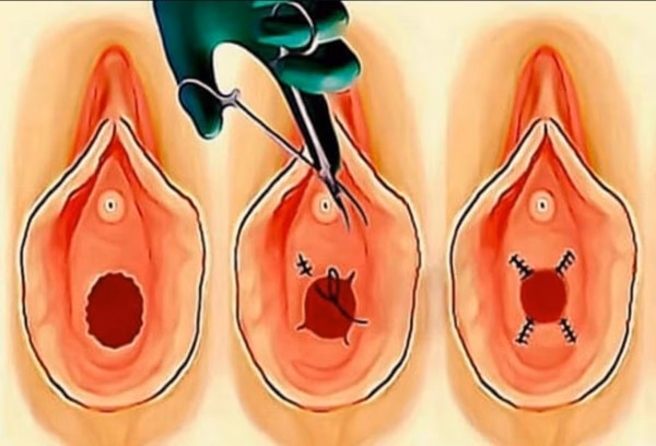 Does hymenoplasty indicate virginity?