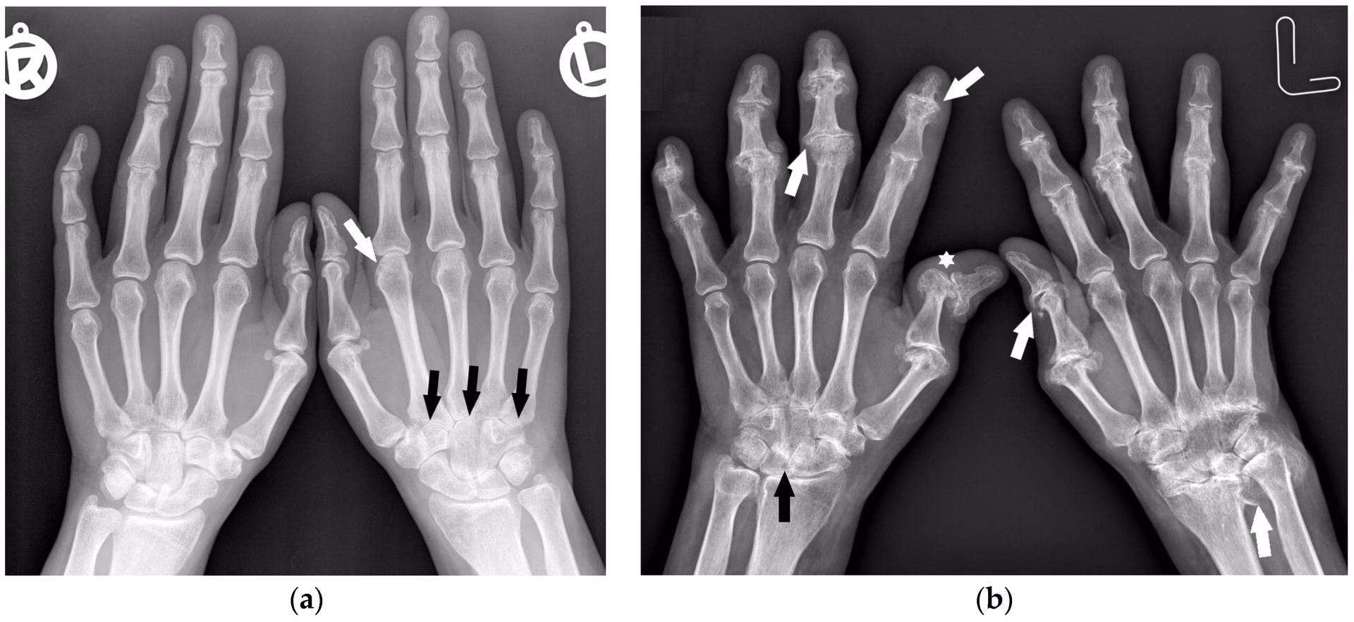What is a normal rheumatoid arthritis level?