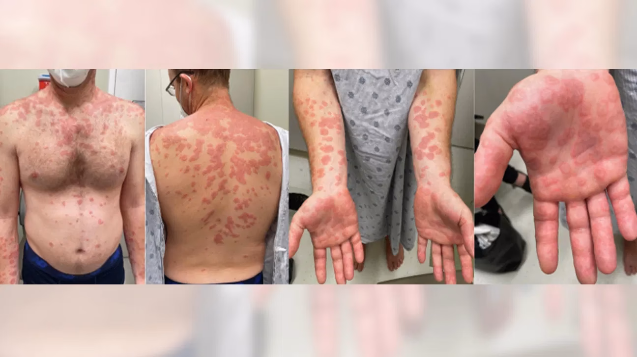 Can allergies cause rheumatoid arthritis?