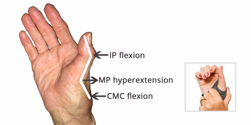What is a zig zag deformity in rheumatoid arthritis?