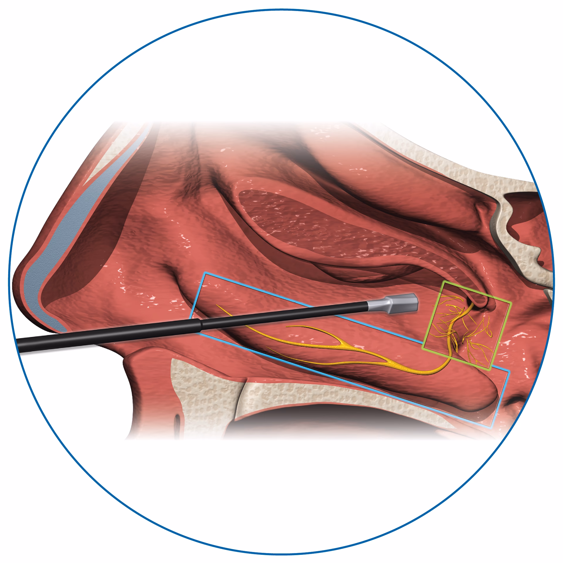 What is the rhinaer® procedure?