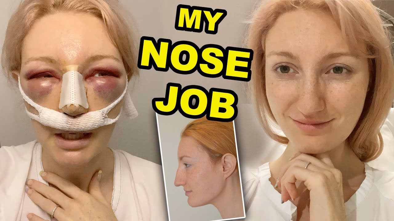 What to expect after rhinoplasty?