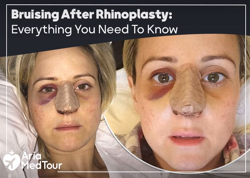 How do you Celebrate rhinoplasty recovery time?
