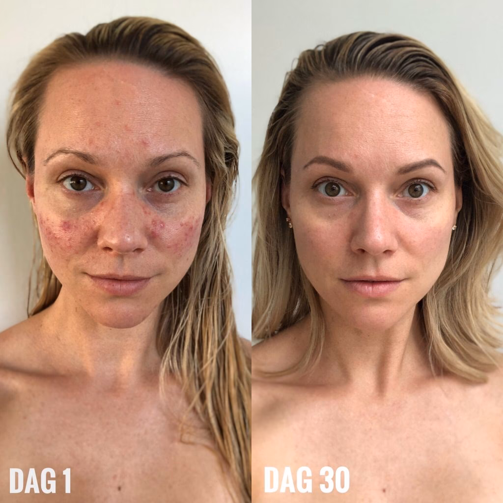 Er rosacea en kronisk sygdom?