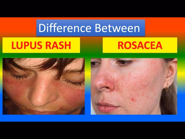 Are rosacea and lupus related?
