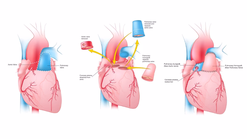 What are the limitations of the Ross procedure?