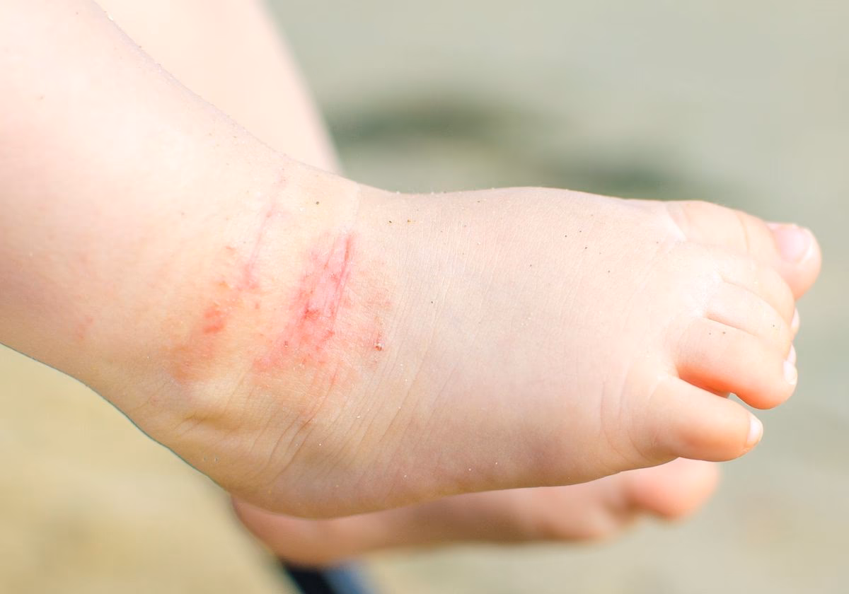 Can a salt shortage cause a histamine reaction?