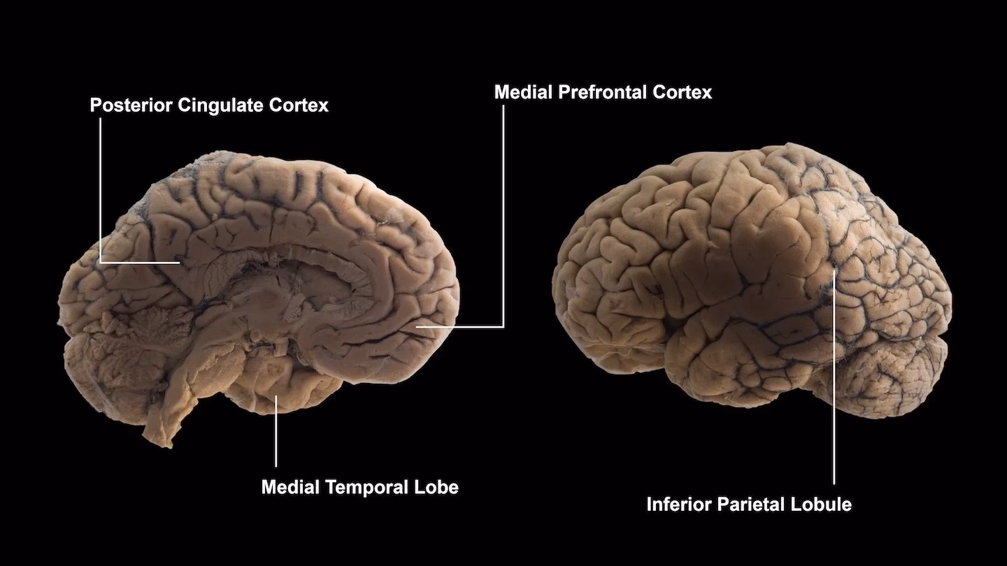 Is schizophrenia a brain disorder?