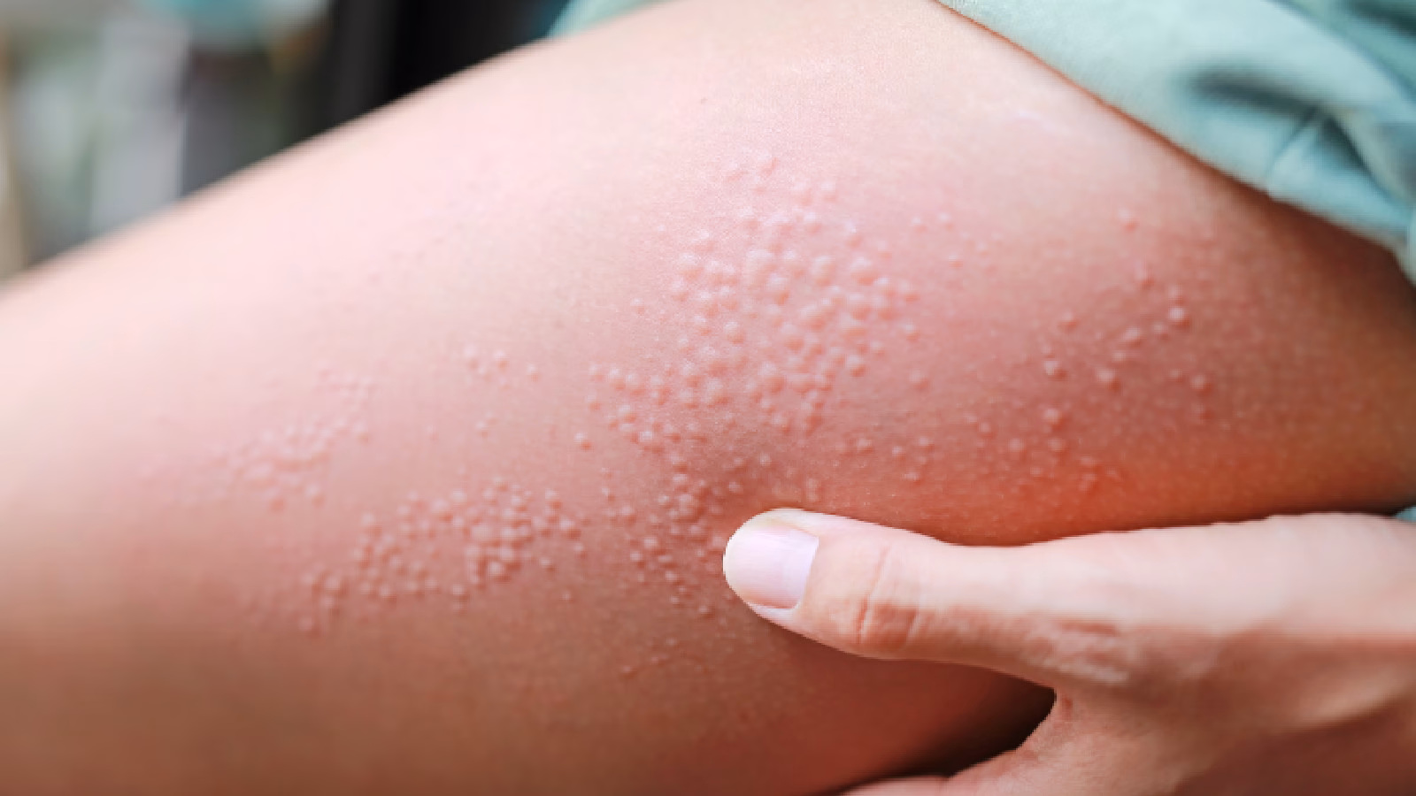 What is a shaving rash?