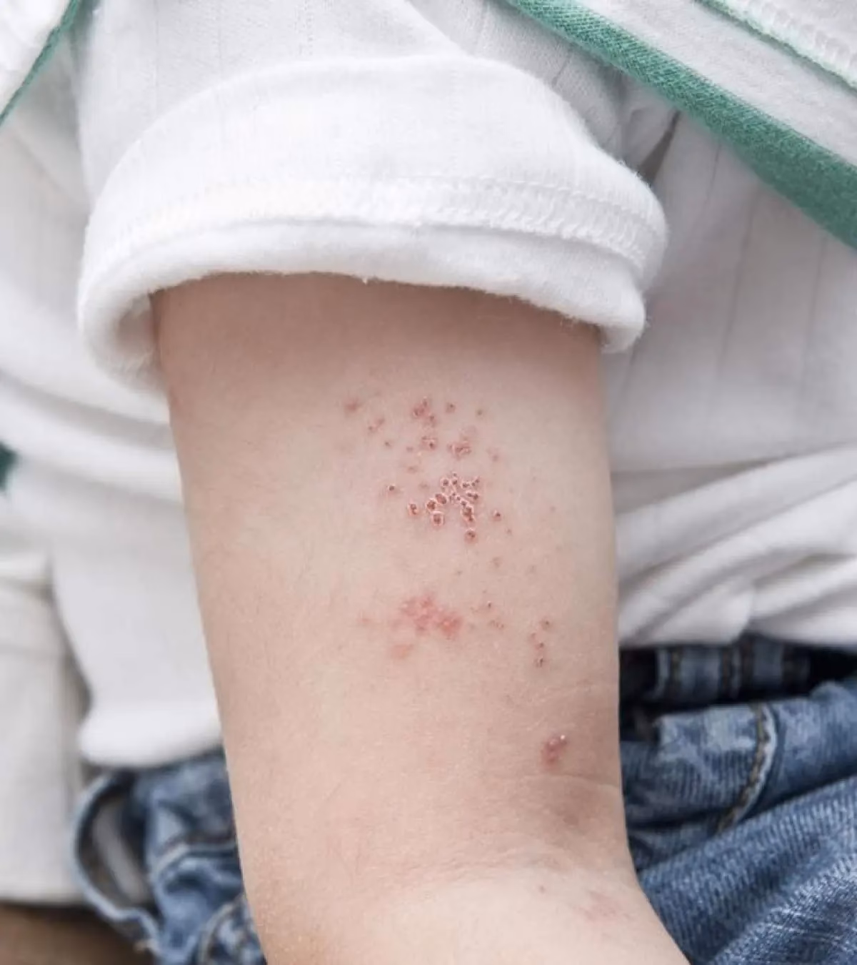 Do children with Hz have a painful rash?