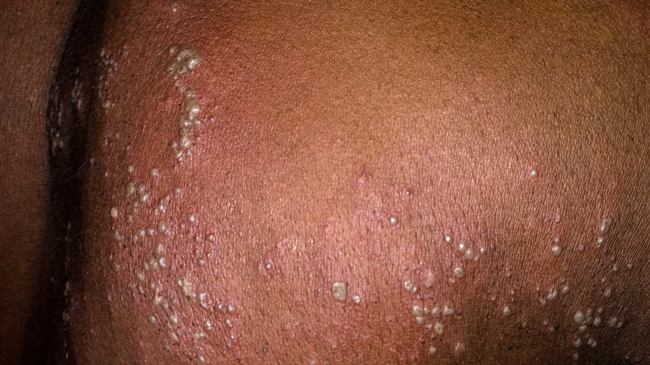 Why are my shingles turning black?