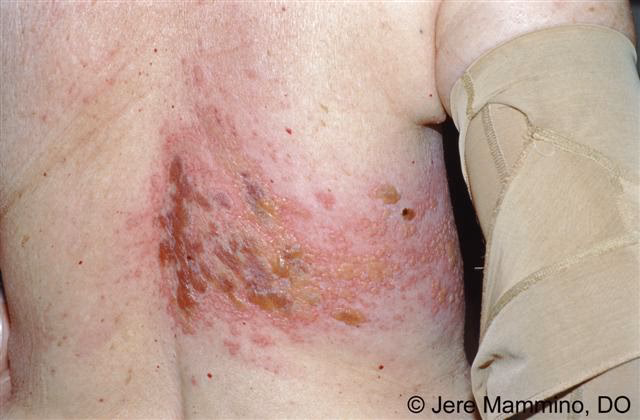 Qu'est-ce que les shigelles?