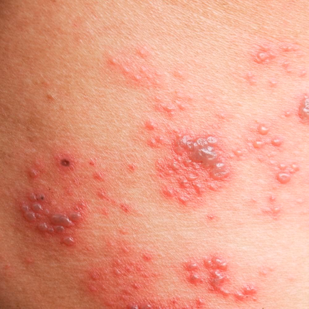 How do you treat shingles?