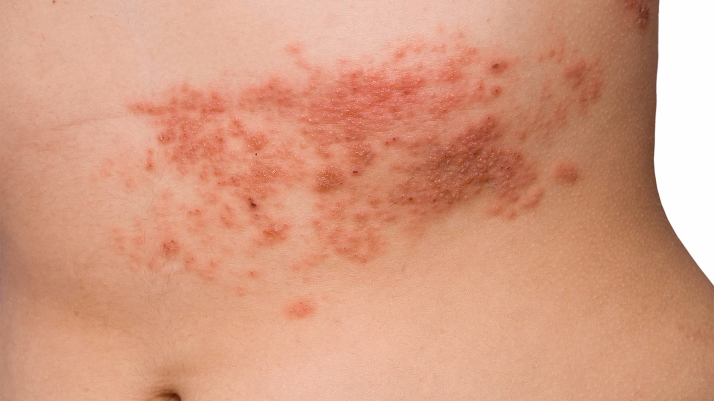Was ist herpes zoster?