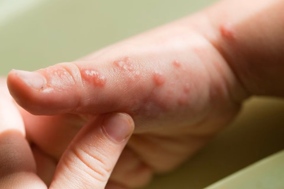 How do you know if a rash is spreading?