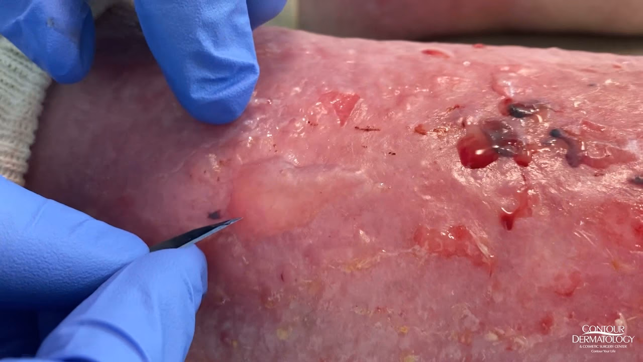 What are asphalt shingles blisters?