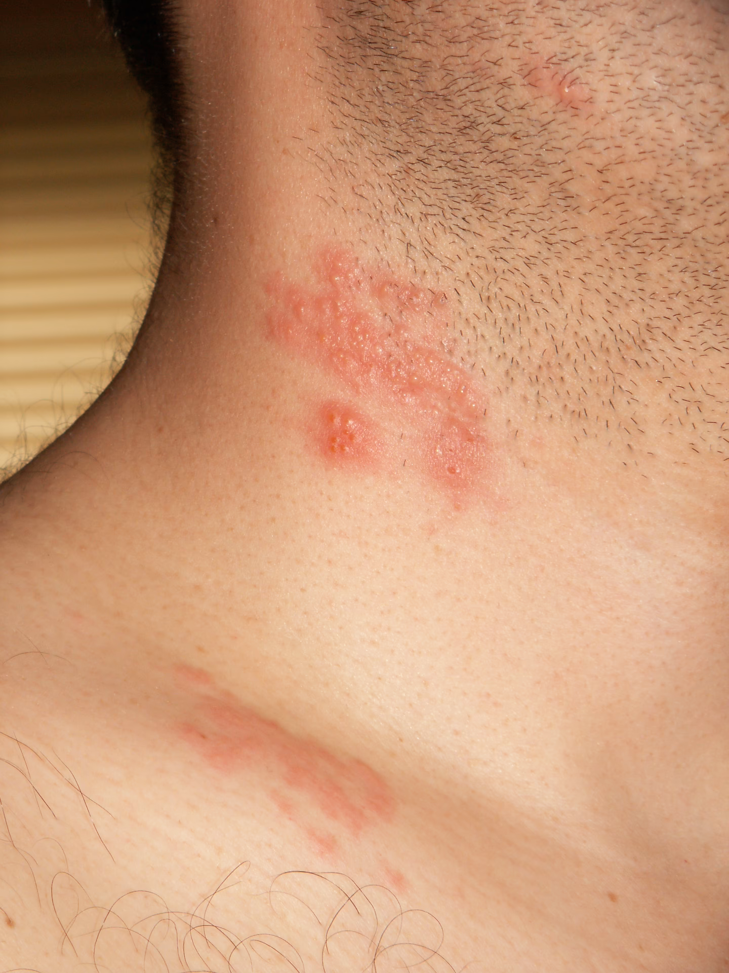 What is Shingles oticus?