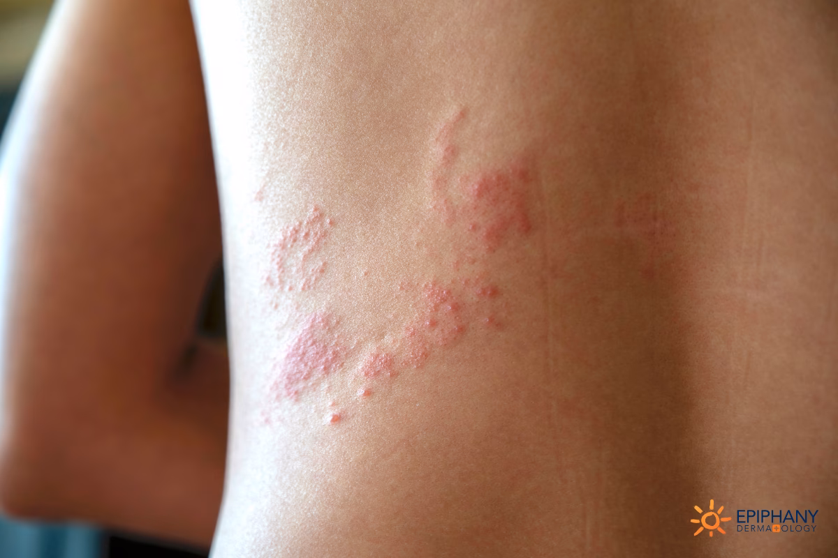 How does stress affect chickenpox reactivation?