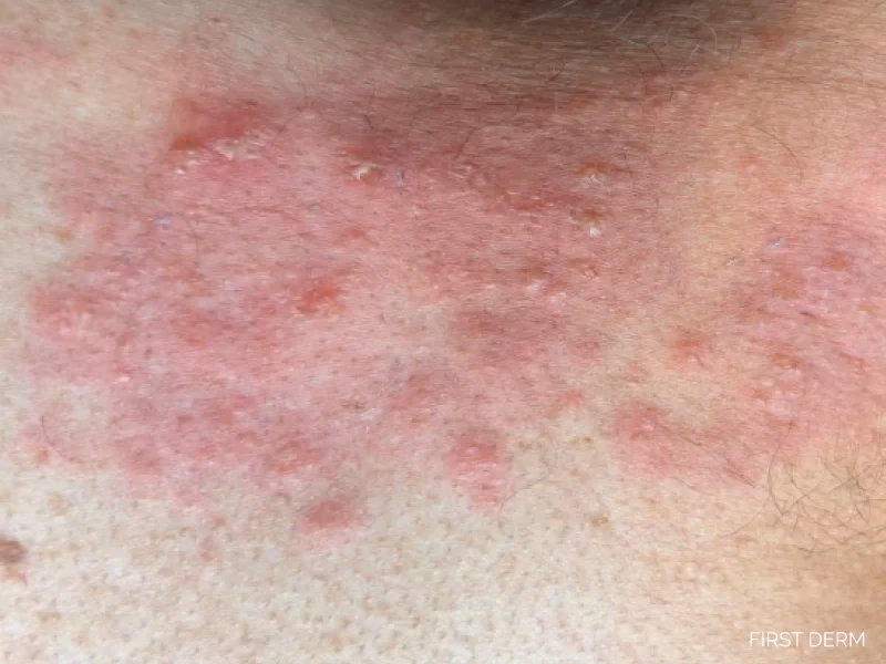 Can heat therapy help shingles rash?