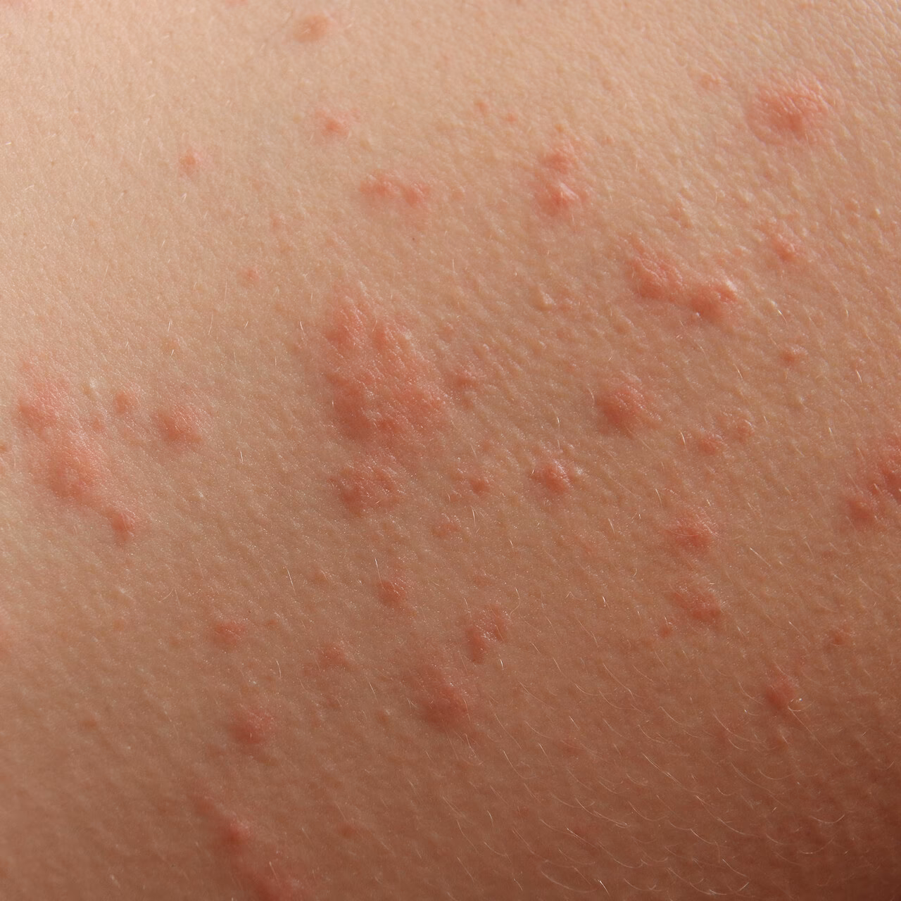 Are hives a sign of a virus?