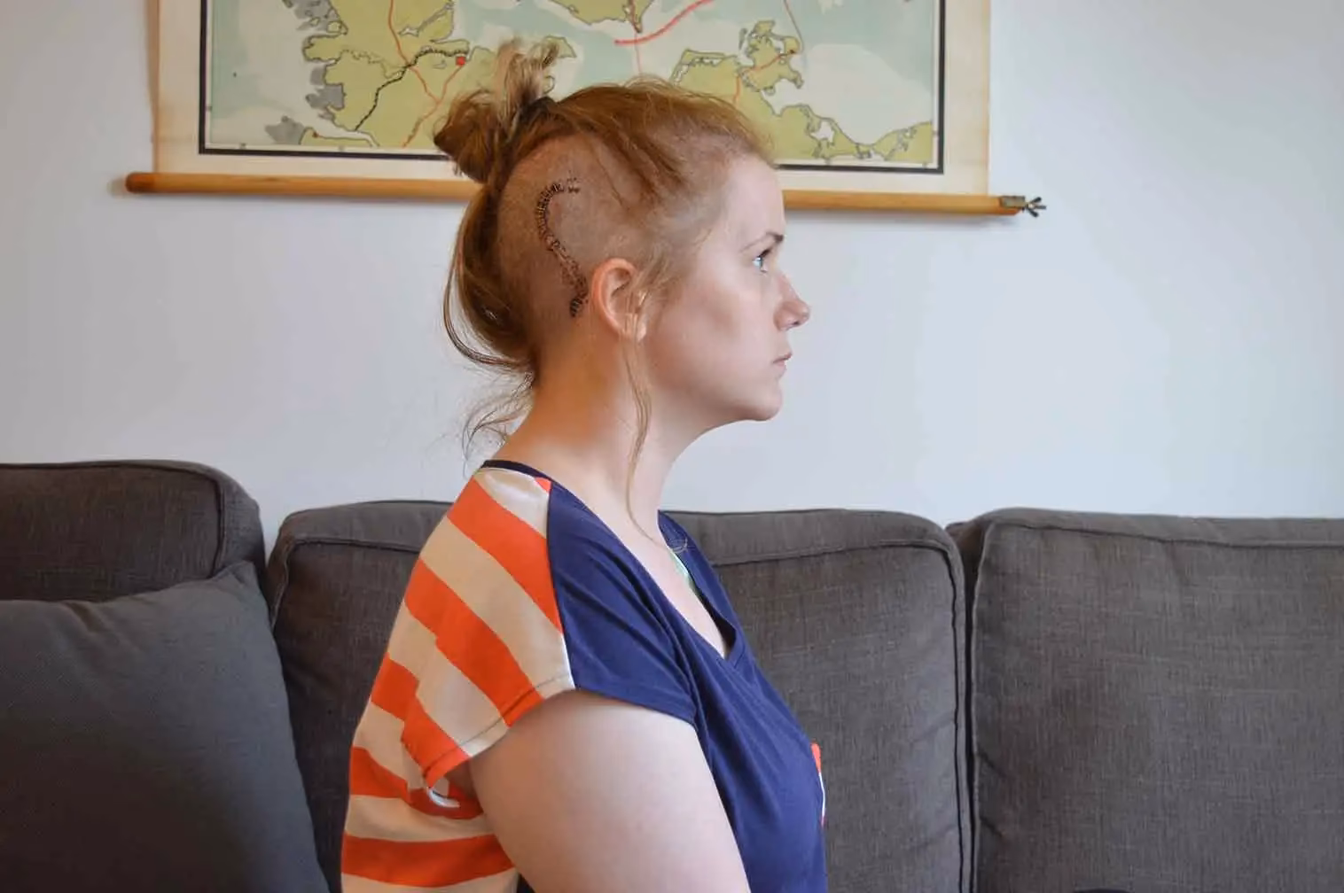 What happens after shunt surgery?