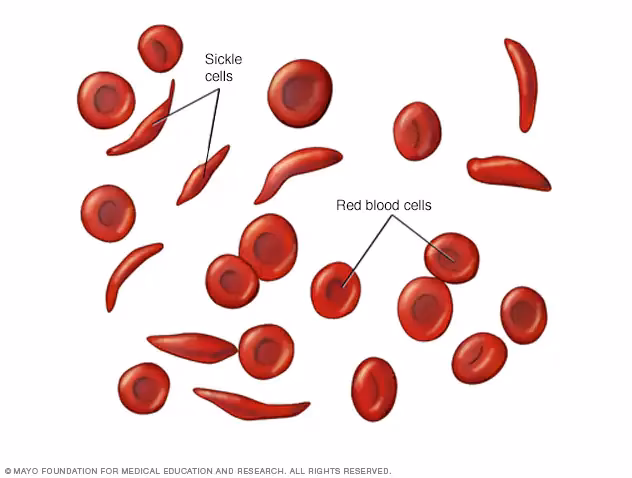 What is sickle cell anemia?