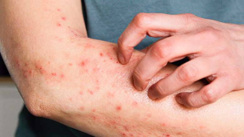 Can simvastatin cause myopathy?