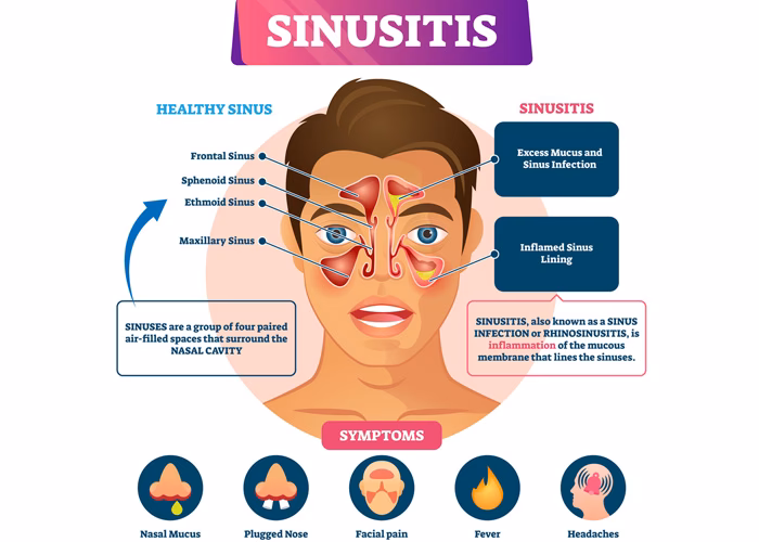 How do you know if you have allergic rhinitis or a sinus infection?