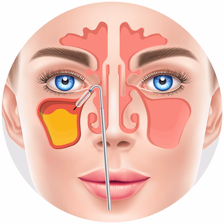 What is a sinus map?