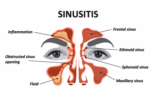 Can sinus pressure cause blurred vision?