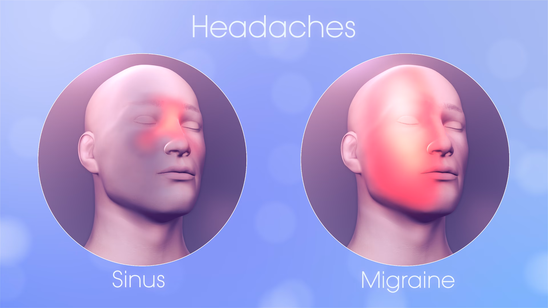 Are sinus headaches and migraine attacks the same thing?