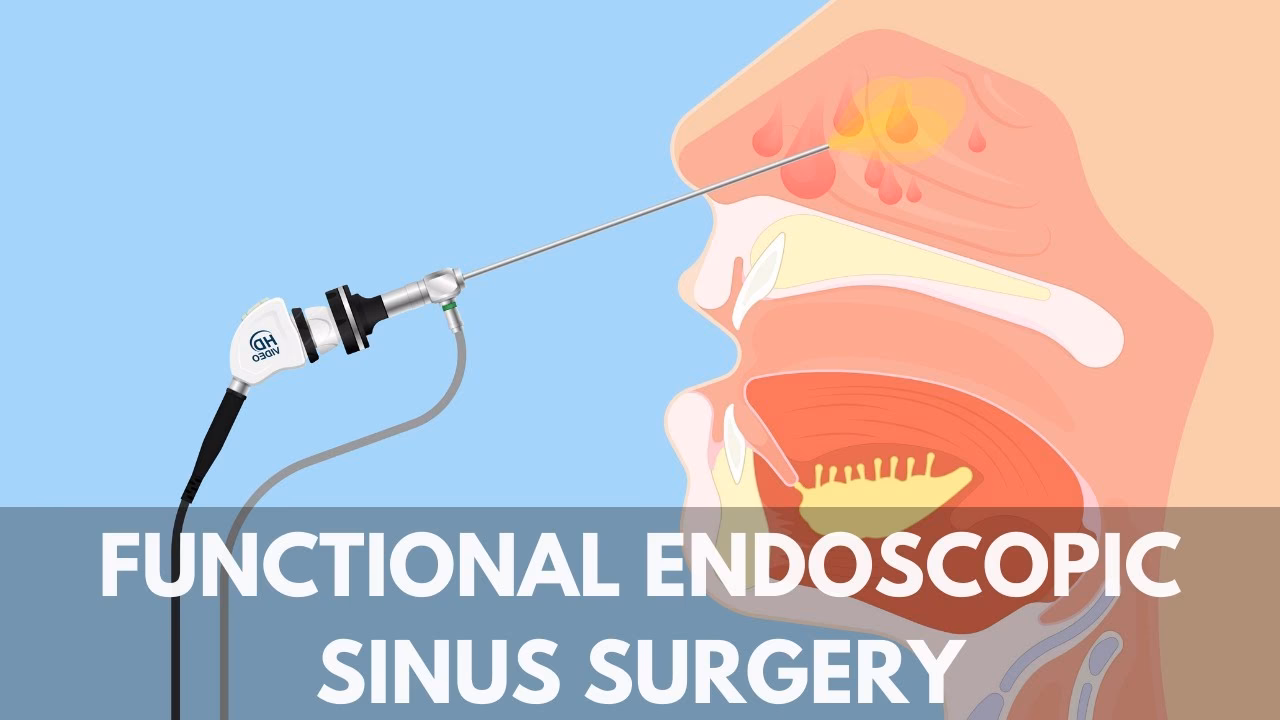 What should I do if I get a sinus infection after surgery?
