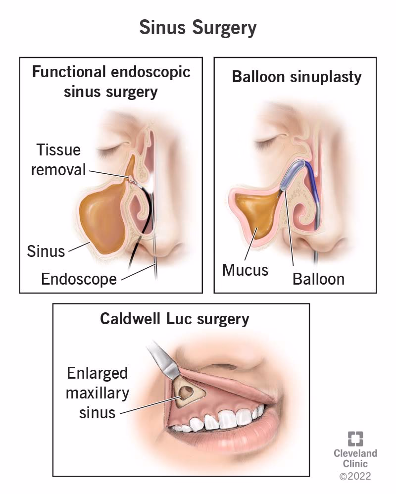What should I do if I get a sinus infection after surgery?