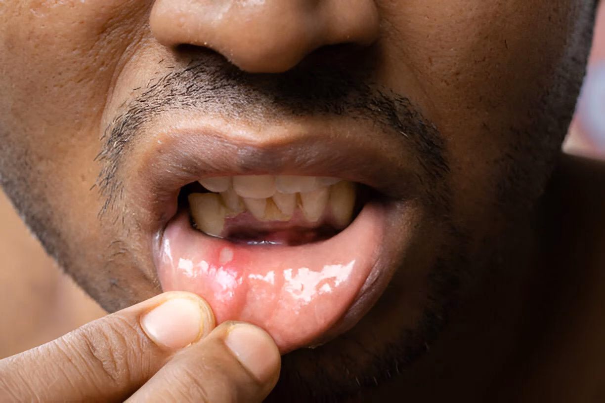 Can a wisdom tooth extraction cause a sore throat?