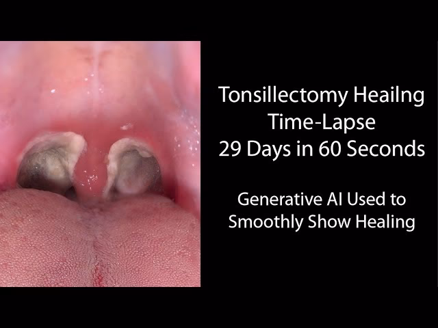 What happens if you have a sore throat after ENT surgery?
