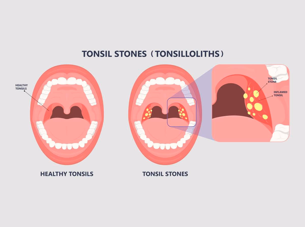 Can pharynx infection cause bad breath?