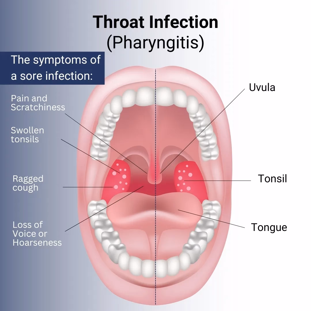 Can a kidney infection cause pain in the lower back?