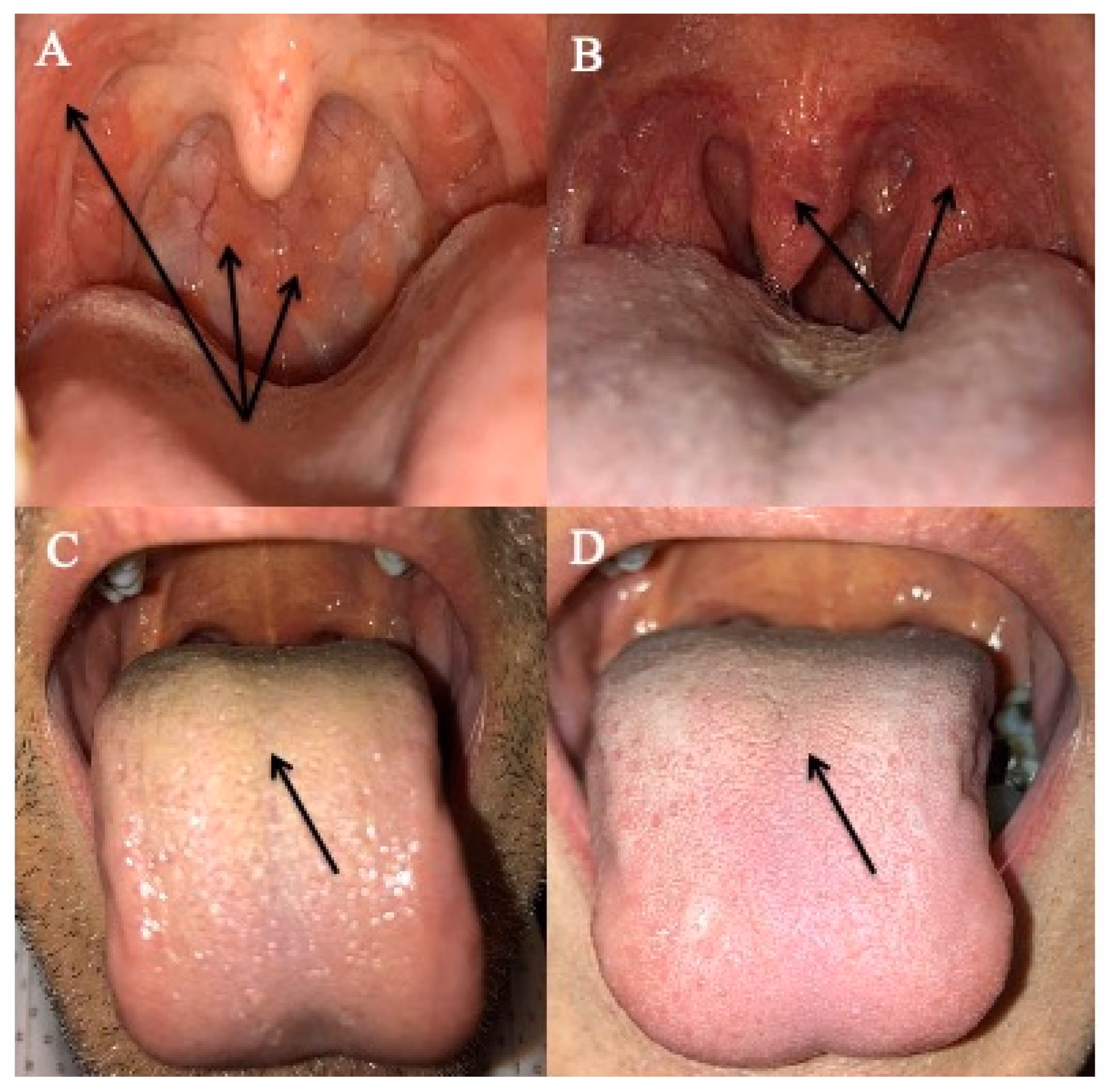Is LPR a symptom of silent reflux?