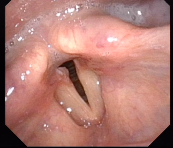 What does LPR stand for oesophageal reflux?