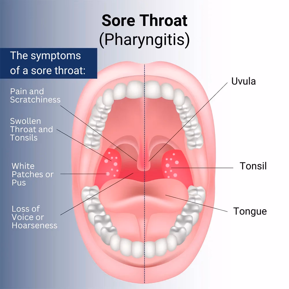 How long does a viral sore throat last?