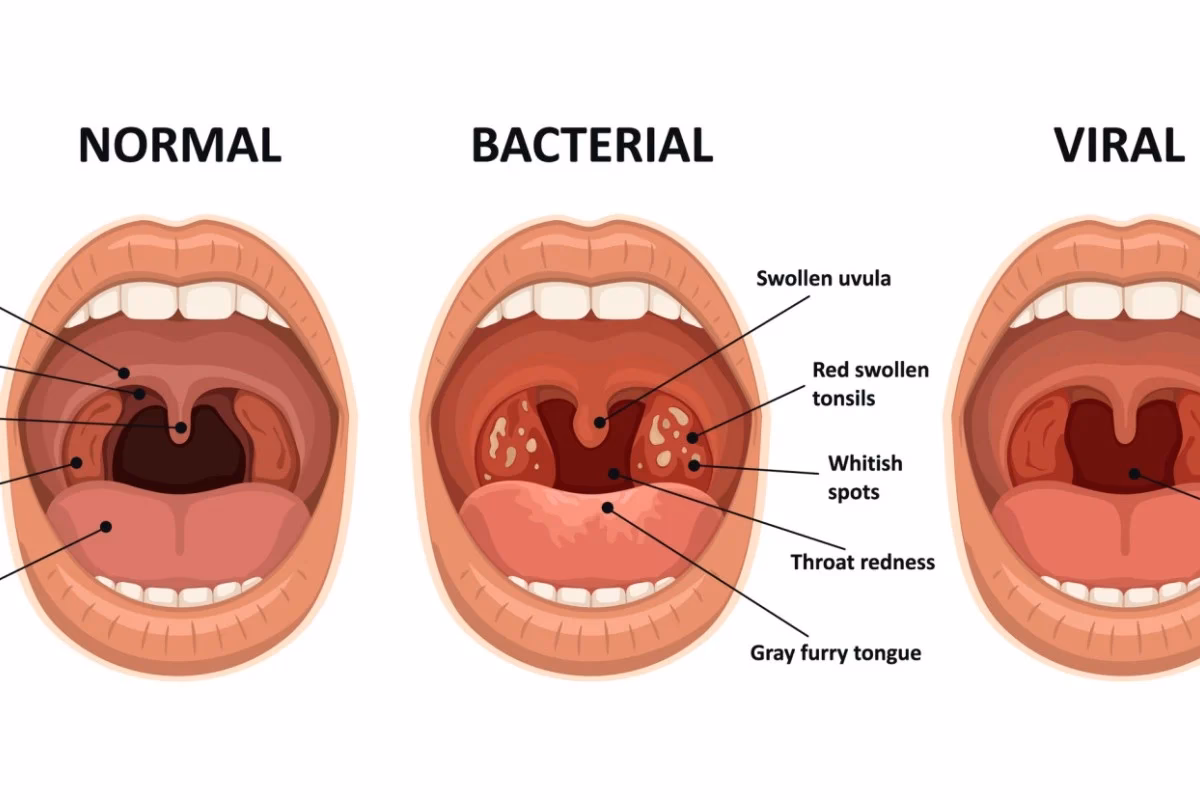 What causes a sore throat and strep throat?
