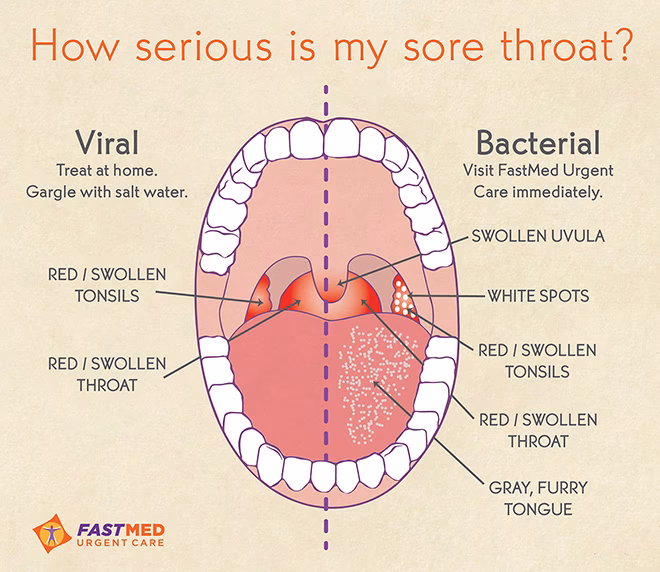 Can A strep throat cause a sore throat?